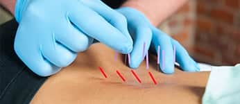 acupunctuur-dryneedling